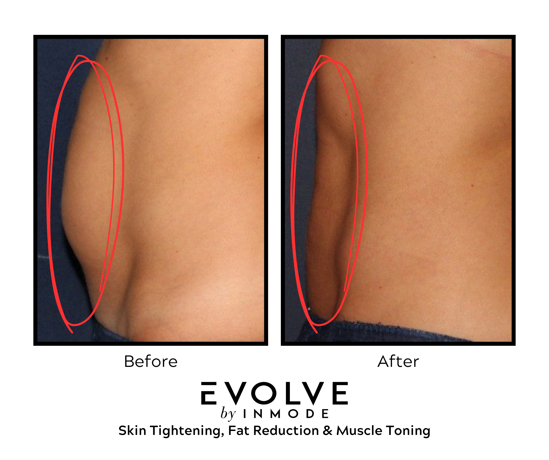 Body Sculpting With TruSculpt: How Does It Work? - Argyle Med Spa